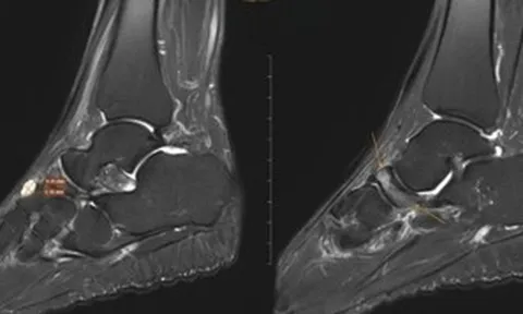 Nữ giáo viên đi khám đau cổ chân, bất ngờ phát hiện bị bệnh 'triệu người có một'