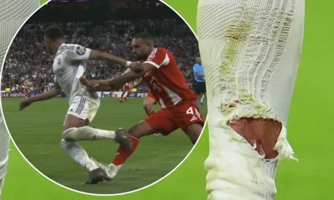 Vết thương gây lo lắng của Mbappe