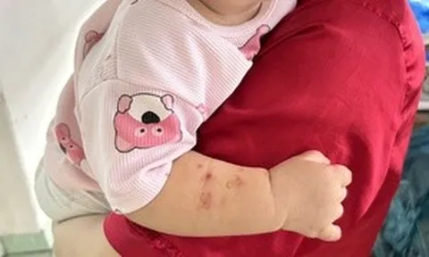 Nhiều ca tay chân miệng nặng tái nhiễm, bác sĩ kỳ vọng sớm có vaccine