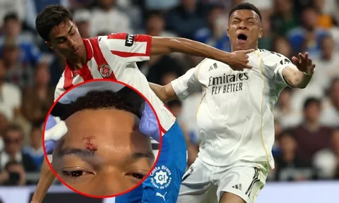 Mbappe gây lo lắng