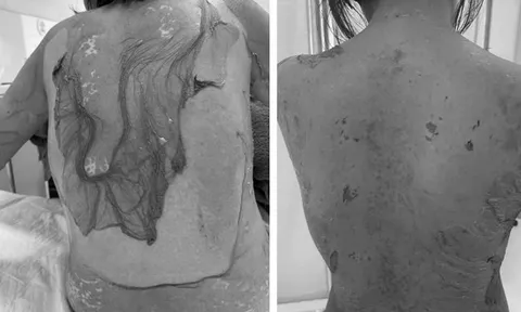 Người phụ nữ 35 tuổi sốc khi da bị tróc như "cua lột"