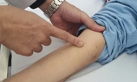 Bệnh não mô cầu gia tăng, bác sĩ cảnh báo triệu chứng dễ nhầm với cảm cúm