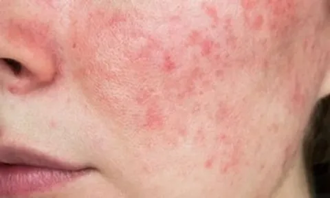 Hiểm họa khi tự ý lạm dụng thuốc, mỹ phẩm chứa corticoid
