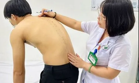 Tưởng đau lưng do tập gym, chàng trai 20 tuổi mắc viêm cột sống dính khớp