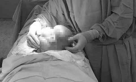 Người phụ nữ 42 tuổi bụng to bất thường, bác sĩ phát hiện thứ "đáng sợ" 3kg bên trong