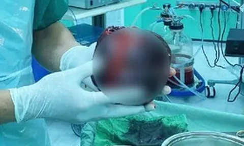 Đau bụng tưởng nhẹ, người đàn ông "sốc nặng" khi phát hiện thứ "đáng sợ" to bằng quả dưa lưới