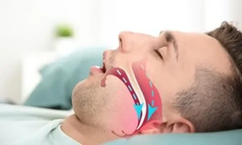 Ngáy to bị vợ giục đi khám, phát hiện căn bệnh có thể dẫn đến đột quỵ