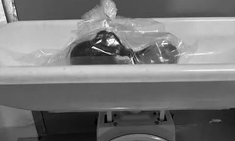 Bé gái 5 tuổi biểu hiện lạ, bác sĩ gắp ra thứ "đáng sợ" trong bụng