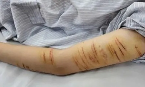 Vết rạch trên tay nữ sinh lớp 10 và nỗi đau không thể nói thành lời