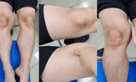 Đùi phình to như quả bóng suốt 1 năm, đi khám phát hiện ung thư hiếm gặp