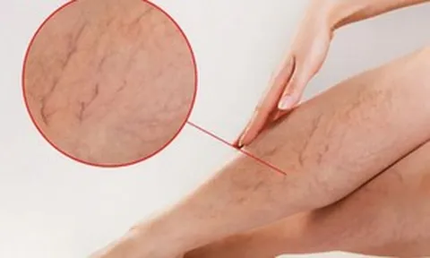 Tưởng mỏi chân do đứng bán hàng, đi khám phát hiện tĩnh mạch hiển suy nặng