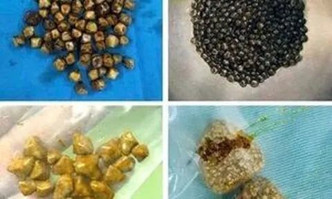 Bác sĩ bất ngờ khi gắp 49 viên sỏi trong túi mật người phụ nữ