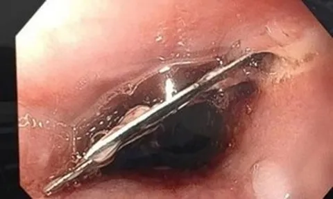 Ăn mì tôm thấy đau họng, đến viện phát hiện lưỡi dao lam trong thực quản