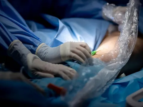 Điều trị suy giãn tĩnh mạch bằng cách xơ hóa tĩnh mạch suy 0