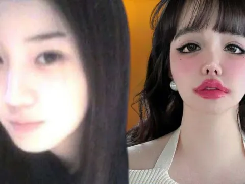 Tiếc cho gương mặt biến dạng của nữ ca sĩ hàng đầu showbiz