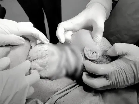 Bé gái chào đời với 6 vòng dây rốn quấn cổ, mẹ tiền sản giật 0