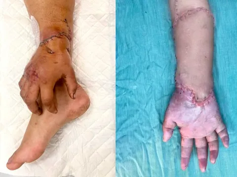Bàn tay đứt lìa của mẹ bầu được nối lại sau thời gian 'nuôi' ở chân 1