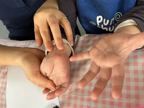 Tưởng con sốt phát ban, bà mẹ tá hỏa khi bác sĩ kết luận tay chân miệng 0