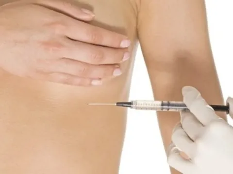 Tiêm filler nâng ngực đón Tết, người phụ nữ nhập viện vì áp xe nặng 0