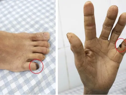 Vết xước do gà đạp khiến người phụ nữ 60 tuổi suýt mất mạng 1