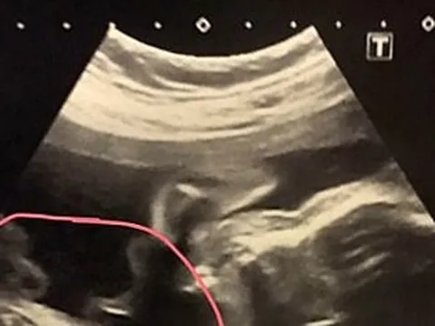 Đi khám thai, người phụ nữ 32 tuổi sốc nặng khi thấy kết quả siêu âm