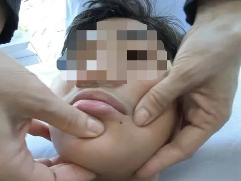 Miền Bắc rét sâu, gia tăng số người bị méo miệng: Chuyên gia chỉ cách bảo vệ sức khỏe "vàng"