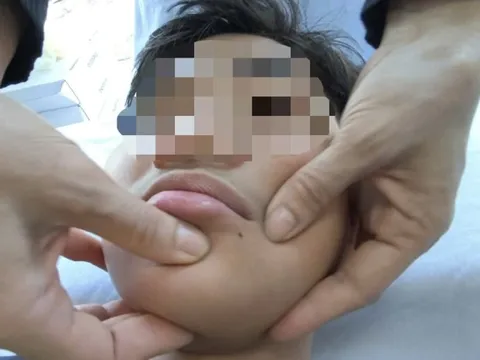 Liệt dây thần kinh số 7 do rét đậm 0