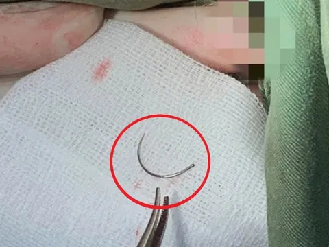 Kim khâu “mắc kẹt” suốt 11 năm trong cơ thể, người phụ nữ đến viện cầu cứu
