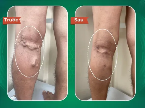 Hồi phục sau điều trị giãn tĩnh mạch tại Dr.Vein 0