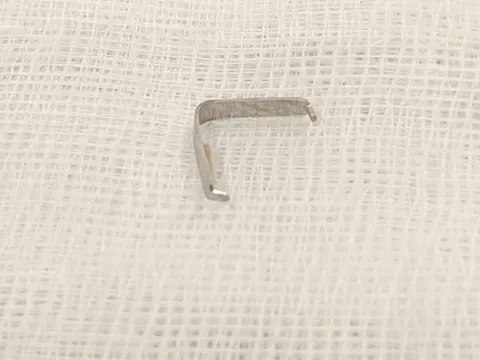 Tưởng con mọc răng, mẹ tá hỏa phát hiện vật sắc nhọn găm trong họng 0