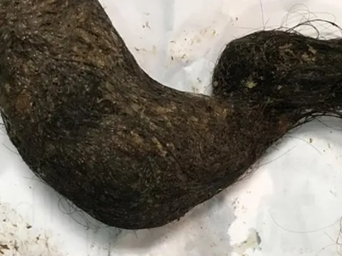 Bé trai bụng cứng như đá, bác sĩ choáng khi phát hiện "bí mật" bên trong