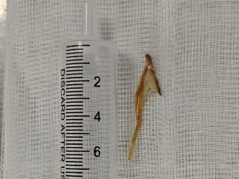 Tưởng bị trĩ hóa ra xương gà dài 3cm mắc ở hậu môn 0