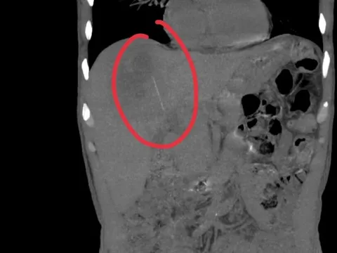 Người đàn ông đau bụng kéo dài, bác sĩ sốc khi phát hiện bí mật bên trong