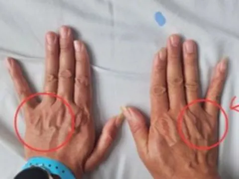 Tê ngón tay út tưởng chuyện nhỏ, người đàn ông suýt teo cả bàn tay 0