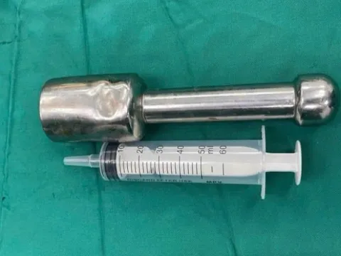 Chiếc chày 18 cm mắc kẹt trong trực tràng nam sinh 15 tuổi