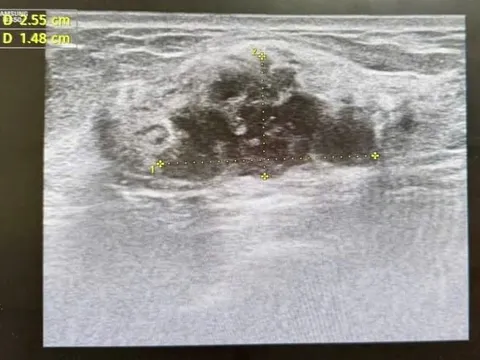 Phát hiện ung thư khi đi khám sức khoẻ định kỳ