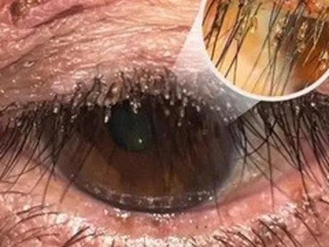 Phát hiện rận mu ký sinh dày đặc trên lông mi người phụ nữ ở Nghệ An