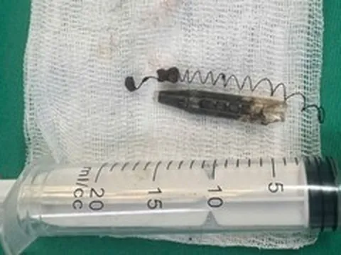 Mang đầu bút bi trong mặt suốt 13 năm không hay biết