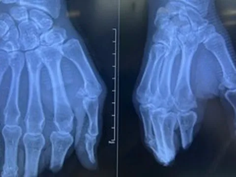 8 giờ vi phẫu nghẹt thở nối lại 4 ngón tay đứt lìa cho người đàn ông