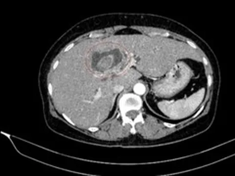 Vàng da tưởng sỏi mật, đi khám phát hiện cùng lúc hai ung thư