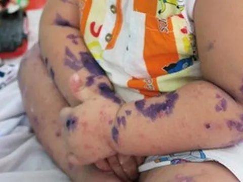 Gần 3.000 trẻ mắc chân tay miệng trong 2 tháng, 3 dấu hiệu cần đưa con đi viện