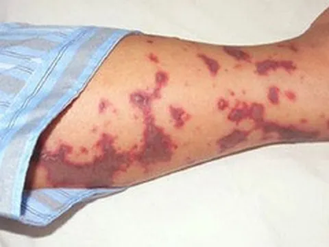 9 bệnh truyền nhiễm nào Bộ Y tế đề xuất phải cách ly y tế?