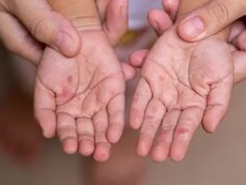 Tác nhân gây ra loạt ca tay chân miệng nặng ở TP.HCM