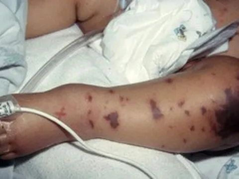 Liên tiếp ghi nhận ca mắc não mô cầu, nhận diện sớm dấu hiệu điển hình