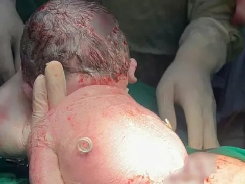 Bí ẩn em bé sinh ra với "đôi cánh nhỏ" trên lưng