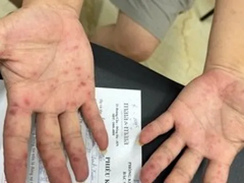 Số ca tay chân miệng tăng mạnh, cảnh báo nguồn lây từ tay nắm cửa, đồ chơi