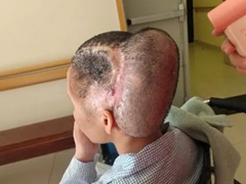 Đột quỵ sau hút mỡ làm đẹp