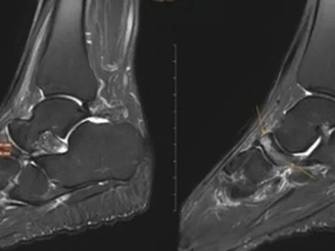 Nữ giáo viên đi khám đau cổ chân, bất ngờ phát hiện bị bệnh 'triệu người có một'