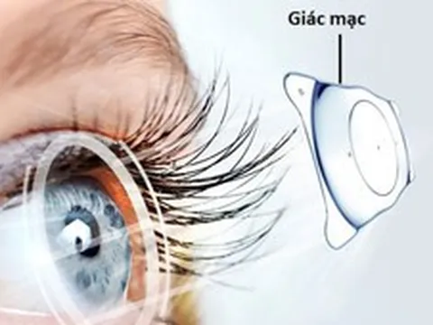 Tìm giải pháp giúp hơn 500.000 người chờ ghép giác mạc