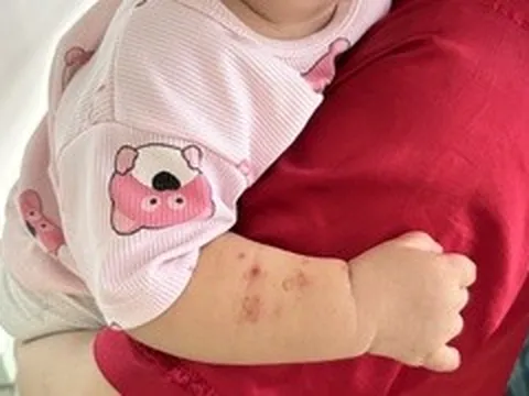 Nhiều ca tay chân miệng nặng tái nhiễm, bác sĩ kỳ vọng sớm có vaccine